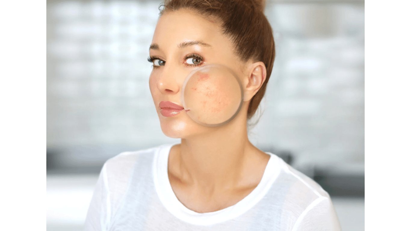 Adult acne